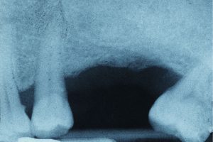 X-ray of missing tooth