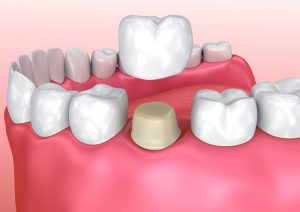 Dental crown